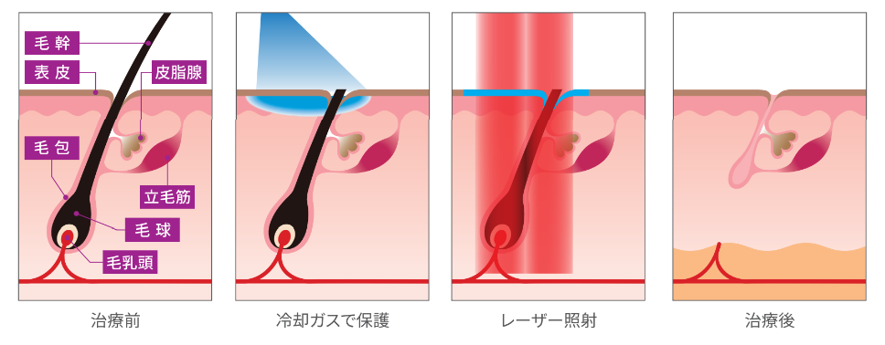 脱毛の流れ